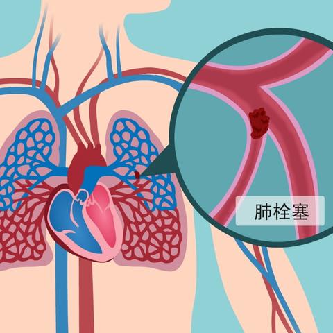 肺栓塞应急演练预案