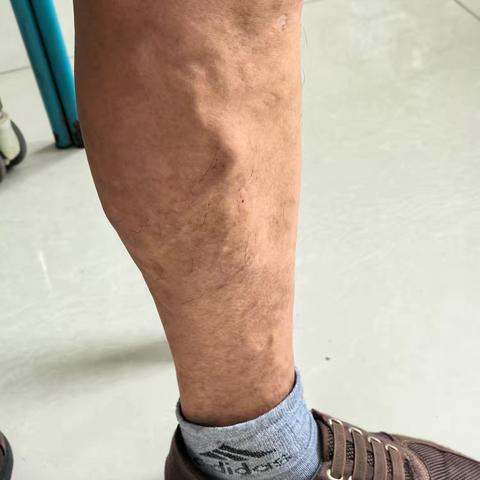 告别“小蚯蚓”    守护美腿大作战！