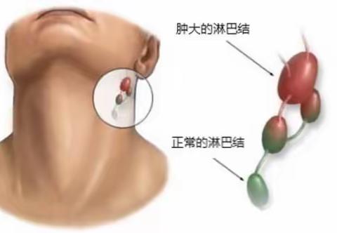 关于淋巴瘤那些事