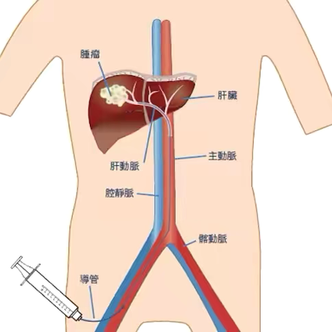 惊险！肝癌破裂出血命悬一线，介入治疗化险为夷！