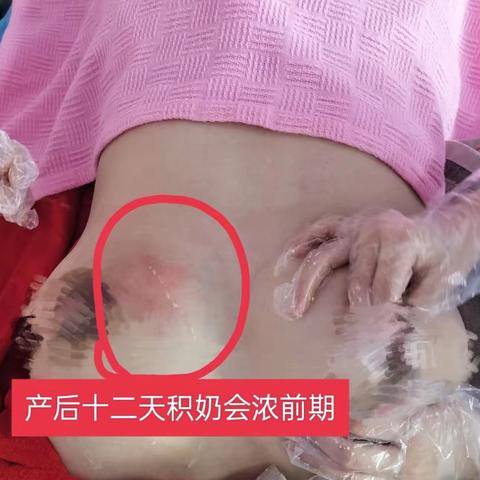 产后乳房涨成“石头奶”痛痛痛，别慌，缓解方法在这！