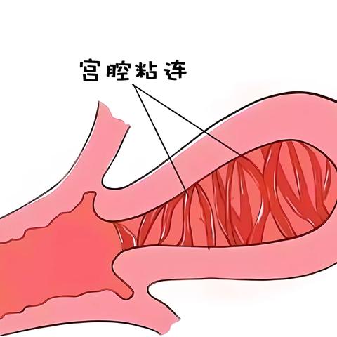 宫腔镜并发症的识别与处理