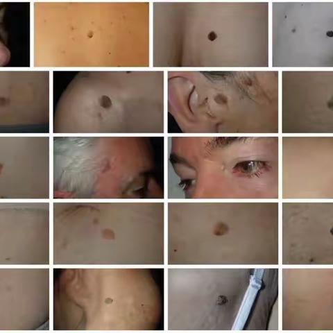 人各有“痣” ﻿可以随意点吗？