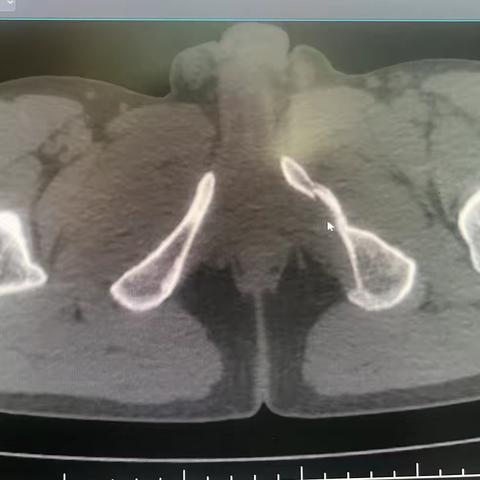 马先生家中摔倒致耻骨骨折：预防与治疗