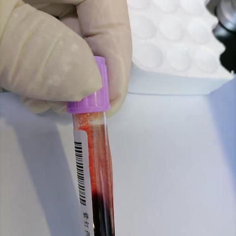 一例血细胞冷凝集标本处理及诊疗思考