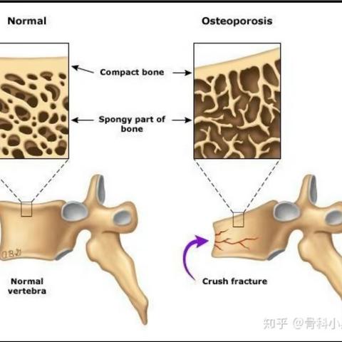 骨密度检查—让您远离骨质疏松