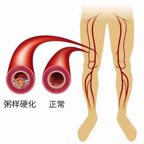 得了下肢动脉硬化闭塞？——试试介入治疗