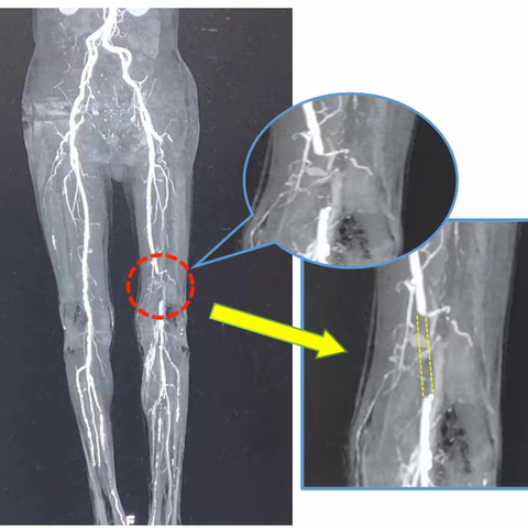 科普：让闭塞的“隧道”再度开通——下肢动脉硬化闭塞症介入开通1例