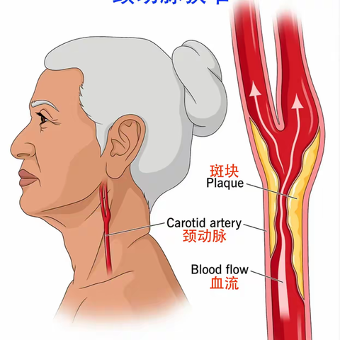 危险！四根脑血管三个重度窄，还有一个闭了！          ——介入科颈动脉支架植入术掐灭导火索