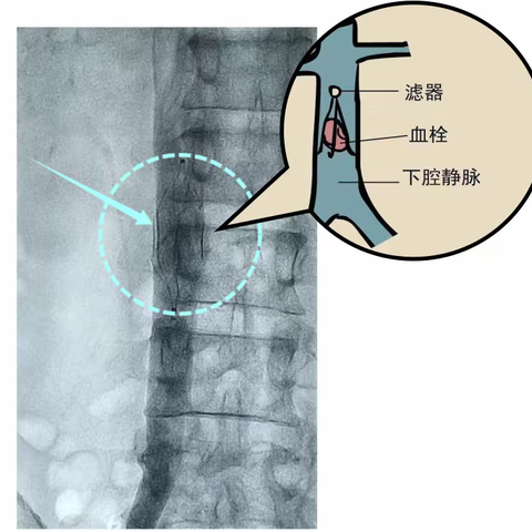 科普：可怕的下肢深静脉血栓形成，警惕致命的肺栓塞！ ——下肢静脉血栓抽吸术1例