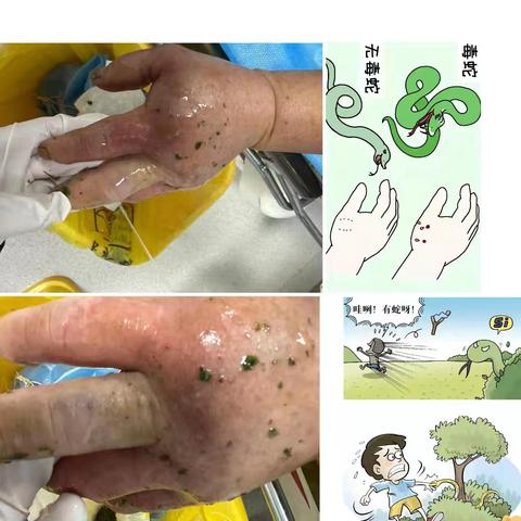蛇毒在体内的“三小时旅程”：如何抢在它前面按下暂停键