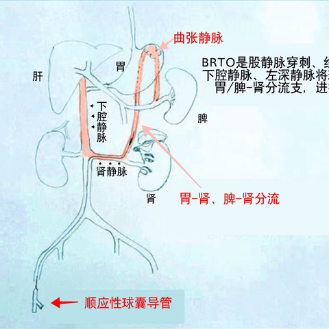 我院消化内科消化内科携手胸外/血管外科完成区内第一例BRTO联合胃镜治疗胃底食管静脉曲张