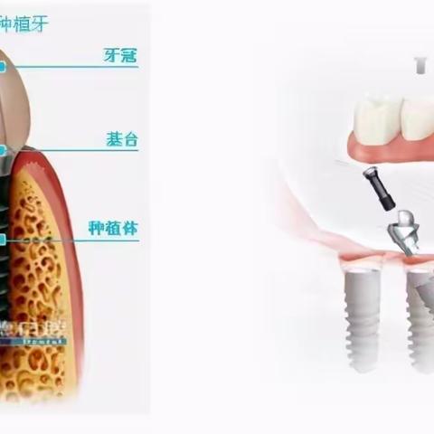 让我们了解种植牙