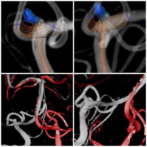 近日主刀手术复盘： PICA动脉瘤翻山支架辅助介入治疗