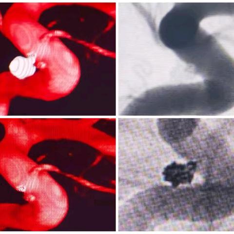 CTA假阴性动脉瘤急诊主刀介入手术一例
