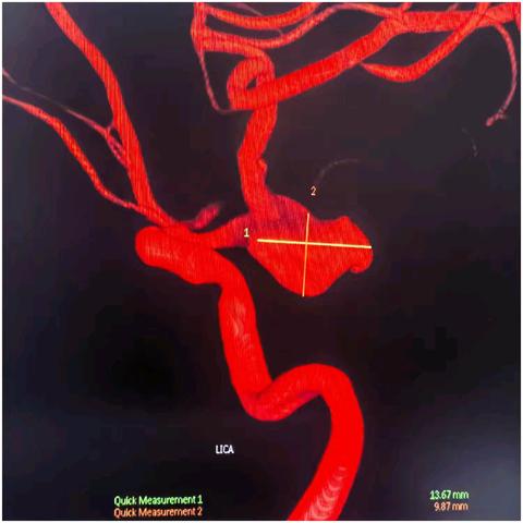 左侧后交通大型夹层动脉瘤