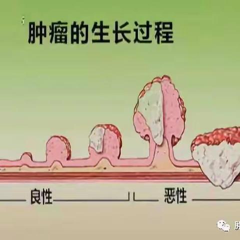 肿瘤那些事——肿瘤是啥？