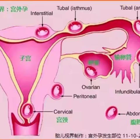 冕宁漫水湾友松医院“宫外孕”小科普