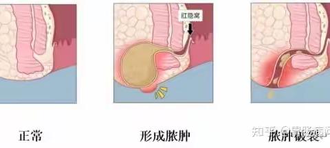 肛肠科医学知识-肛周脓肿