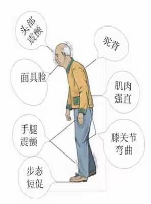 帕金森患者如何做康复保健