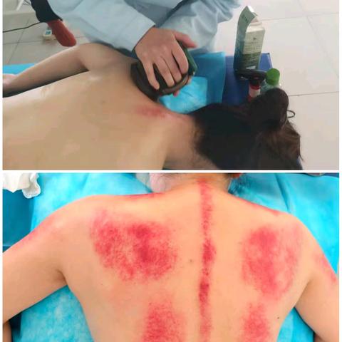 磁县第二医院中医科开展火龙罐特色理疗