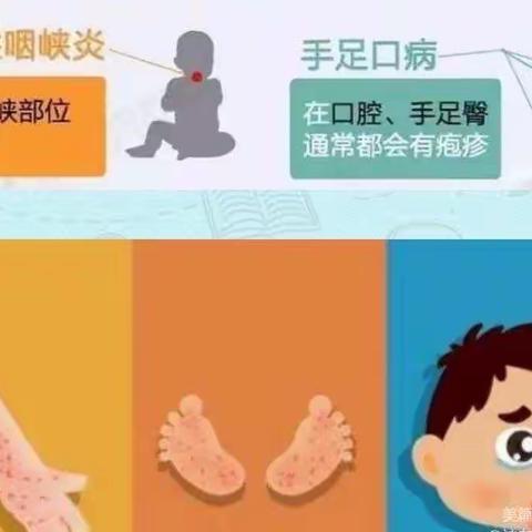 关于预防【疱疹性咽峡炎！手足口病！诺如病毒！】金桥幼儿园温馨提示