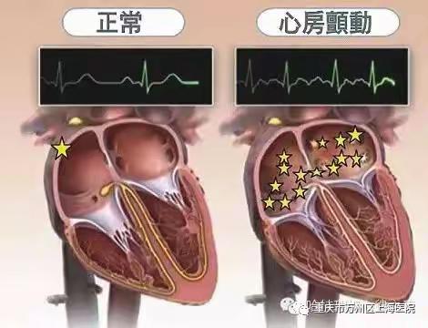 房颤患者健康指导