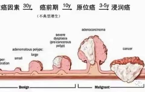 肠癌——人类杀手