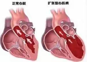 “心有余”而力不足？什么是扩张型心肌病？