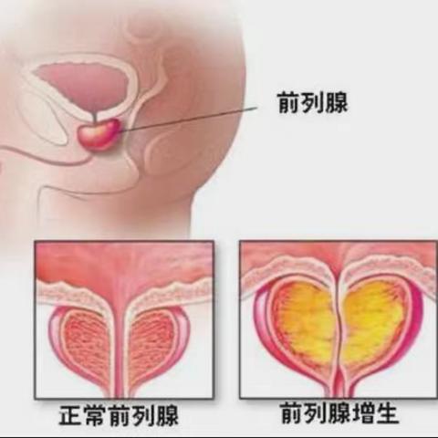 中医中药特色疗法治疗男性前列腺疾病