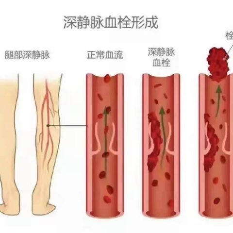 康复医学科带您了解隐形杀手——“静脉血栓栓塞症”（VTE）