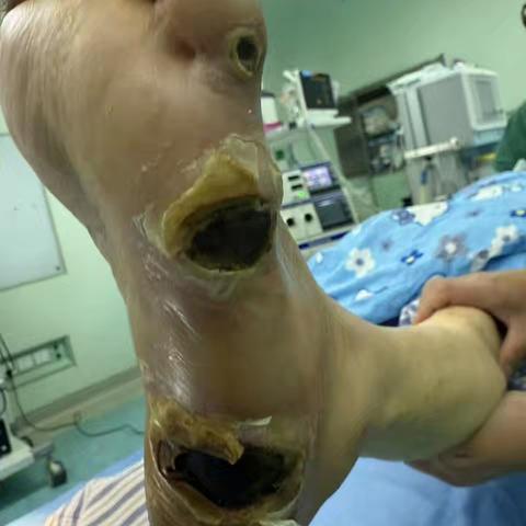 糖尿病足中西医结合治疗