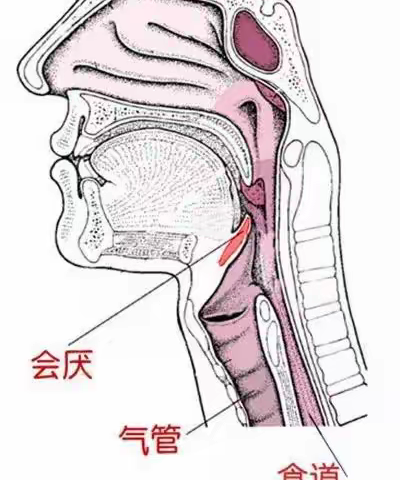 吞咽障碍患者如何预防误吸