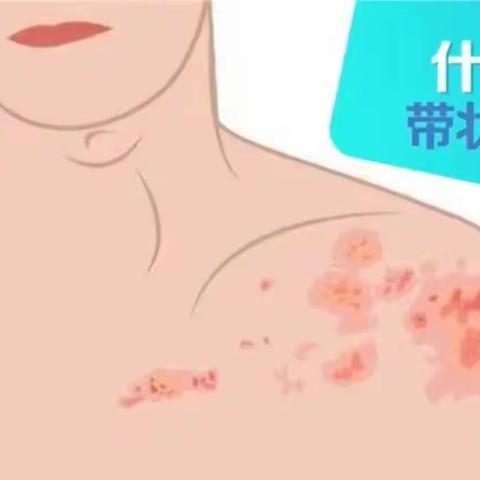 带状疱疹