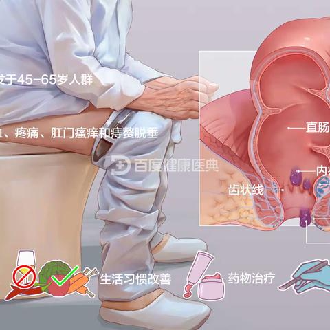 健康科普之痔疮