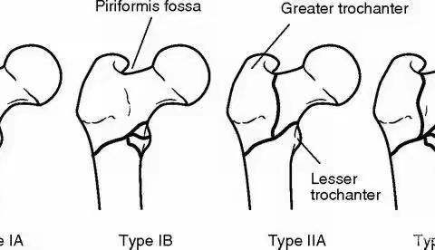 股骨粗隆骨折科普