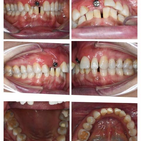 前牙修复病例