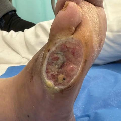 糖尿病足与下肢动脉硬化闭塞症：警惕这对“脚的隐形杀手”