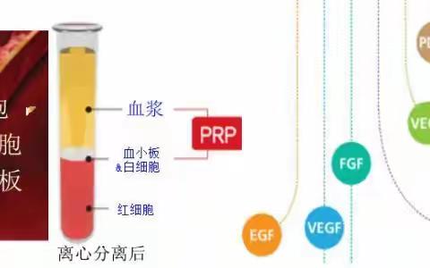 自体血小板PRP注射，一针解决膝关节炎的困扰！