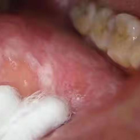 简单介绍扁平苔藓