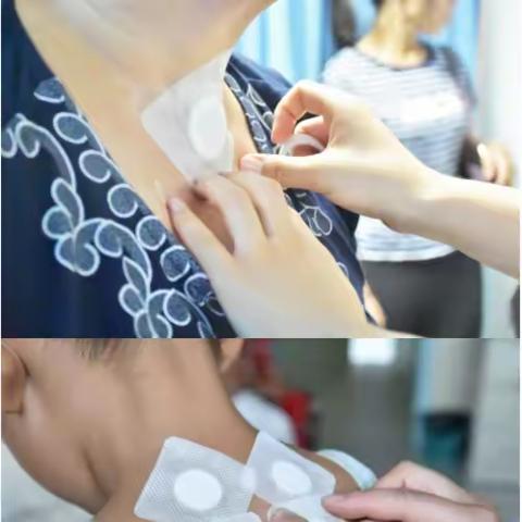 龙头卫生院穴位贴敷治疗
