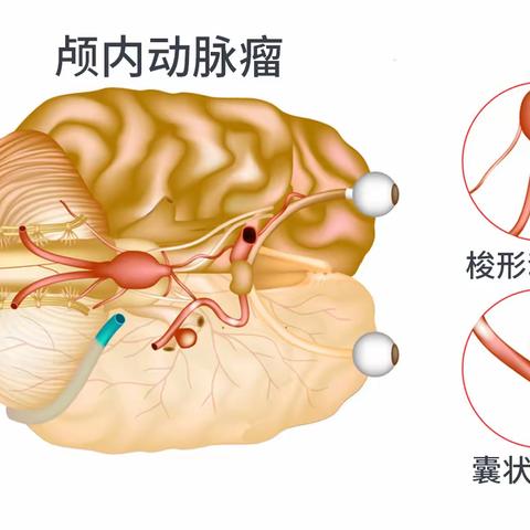 颅内动脉瘤健康宣教