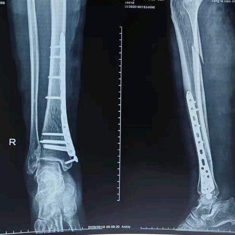 【医疗技术】康乐县中西医结合医院外二科完成一例胫骨远端骨折微创钢板内固定术（MIPO）