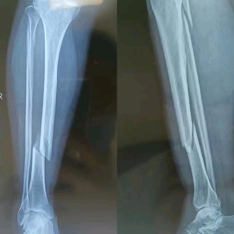 【医心为民】康乐县中西医结合医院外二科成熟开展微创手术——胫骨骨折闭合复位髓内针内固定术