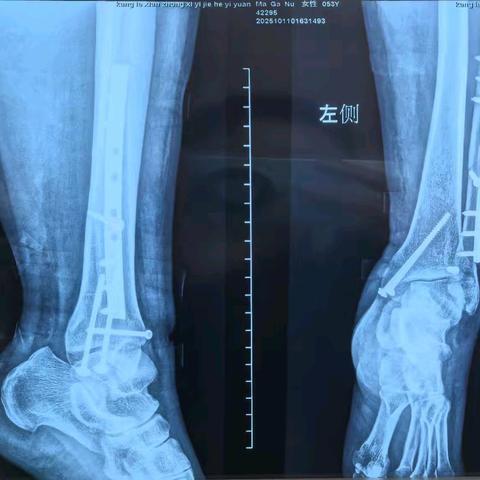 关“踝”备至--康乐县中西医结合医院外二科完成一例左侧踝关节骨折+左侧腓骨骨折切开复位内固定术
