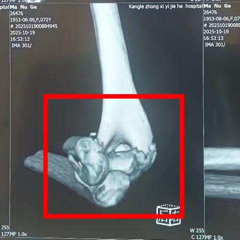 【病例分享】康乐县中西医结合医院外二科完成一例肱骨极远端粉碎性骨折切开复位双钢板内固定术