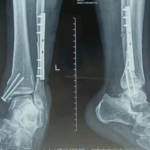 康乐县中西医结合医院外二科完成一例左侧内踝骨折＋左侧腓骨骨折切开复位内固定术＋左侧下胫腓联合分离带袢钢板内固定术