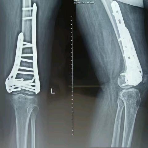 康乐县中西医结合医院外二科完成1例复杂股骨髁合并双侧Hoffa骨折切开复位双钢板内固定术