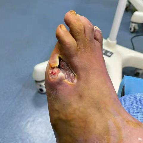 糖尿病足疗效显著