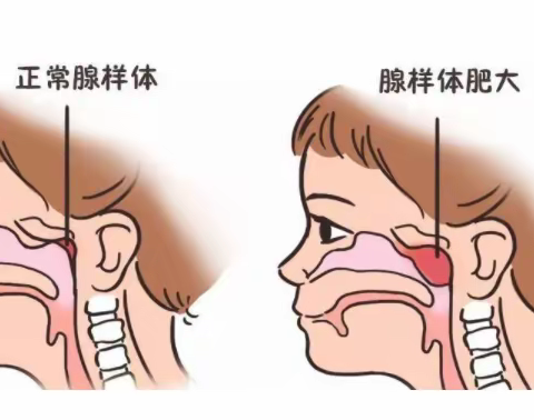 腺样体肥大科普及病例分享